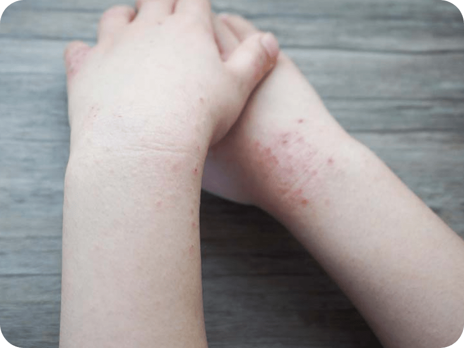 アトピー性皮膚炎の症状